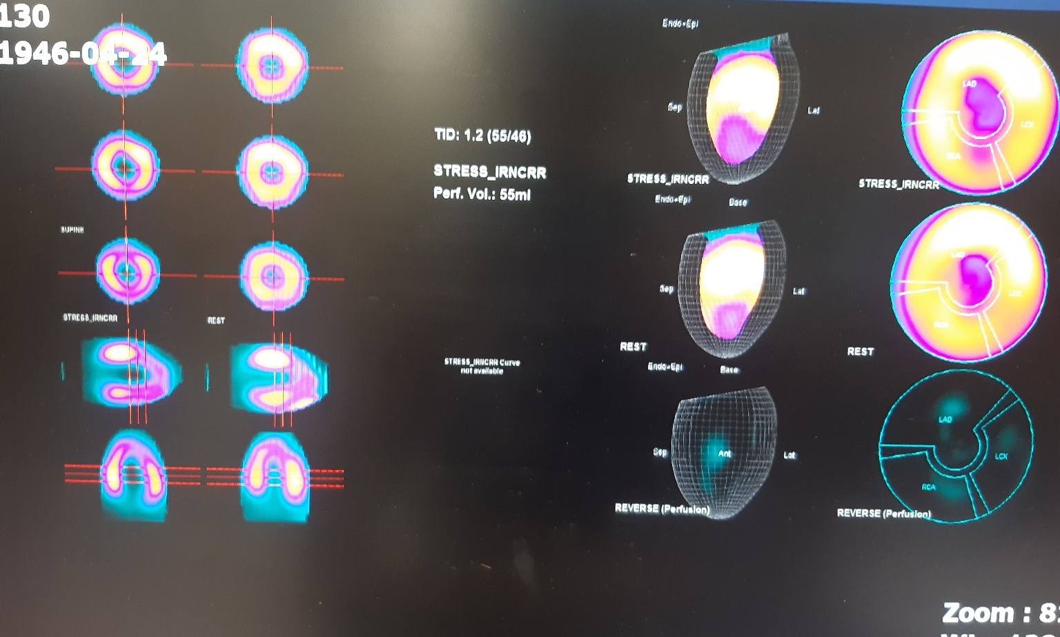 ? Understanding Myocardial Perfusion Imaging (SPECT/PET) ? 1️⃣ 