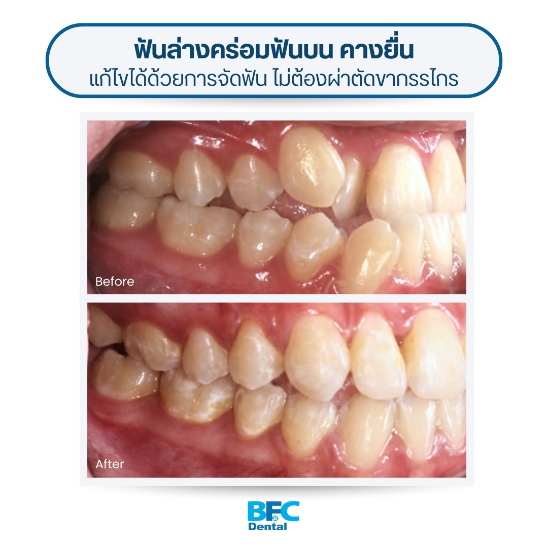 BFC Dental - 🦷 เคสจัดฟันแก้ ฟันล่างยื่น ฟันล่างคร่อมฟันบน... | Facebook