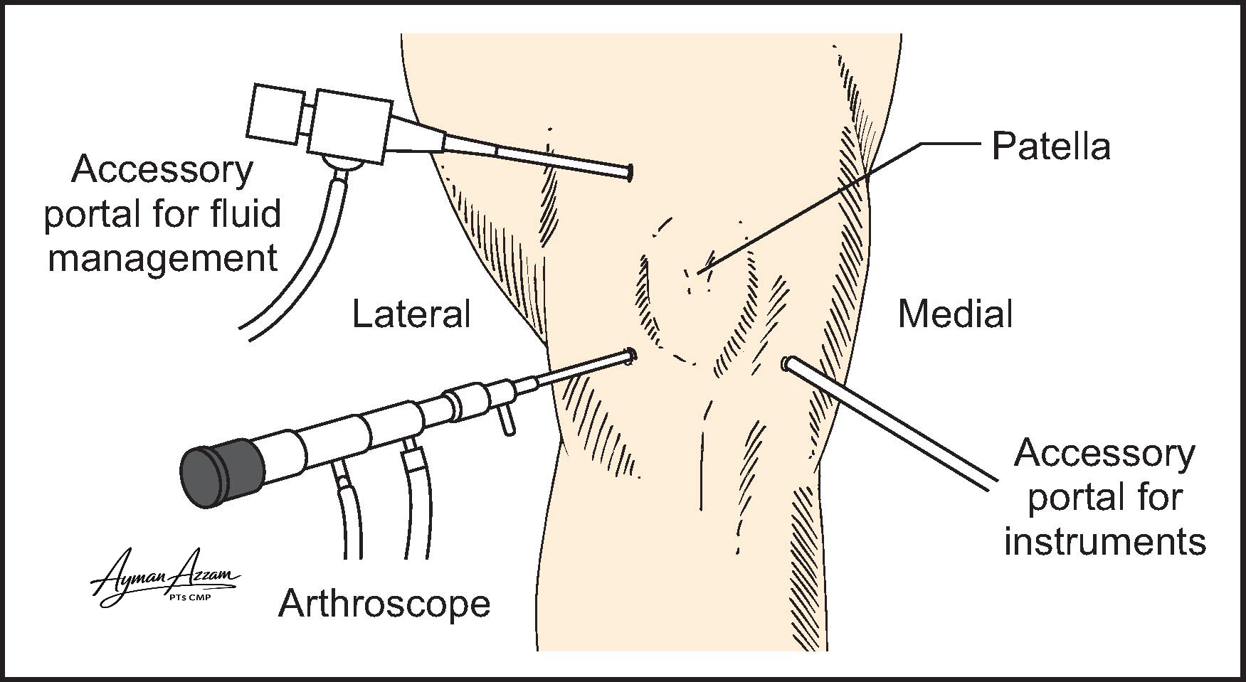 Knee Arthroscopy... - Ayman Azzam PTs CMP Educational Page | Facebook