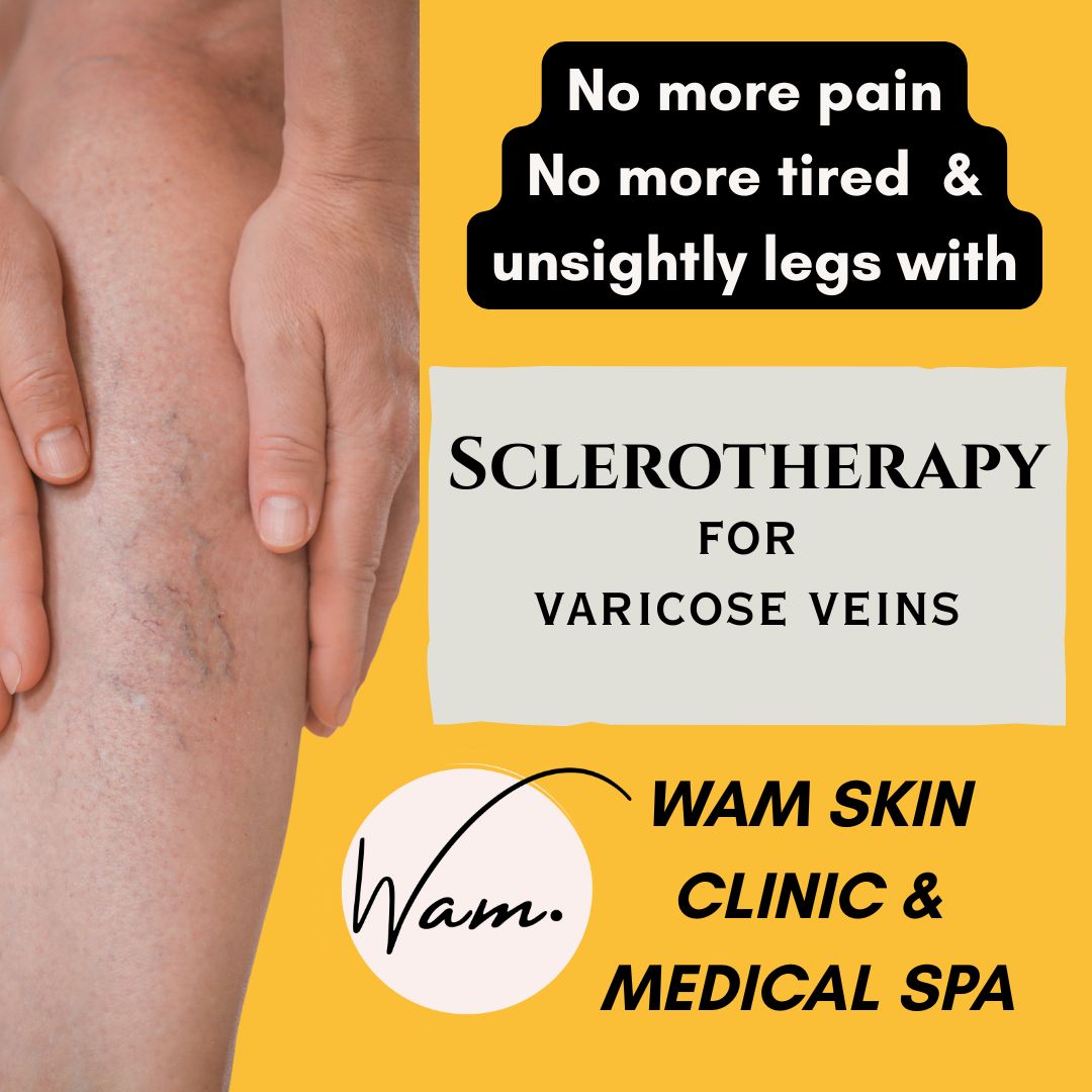 glutathione varicose veins Sclerotherapy is the gold standard for the treatment of Avail this treatment by a board certified dermatologist in WAM SKIN CLINIC & MEDICAL SPA located at 2nd Floor, West Wing! Healthy Scalp The Peptide Gamble: A Color:9CC Intense Ash Lightest Blonde