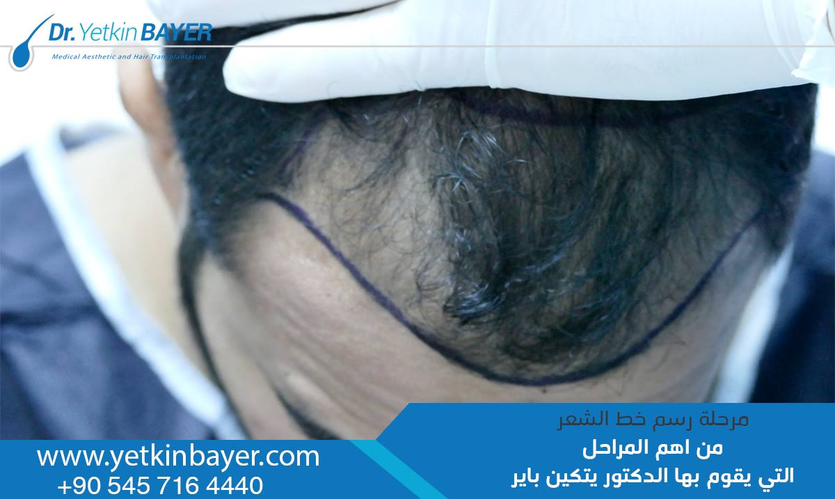 زراعة الشعر في تركيا Yetkin Bayer مرحلة رسم خط الشعر من اهم المراحل التي يقوم بها الدكتور يتكين باير زراعة الشعر في تركيا زراعة شعر زراعة الشارب زراعة اللحية زراعة الذقن زرعة الحواجب الدكتور يتكين باير افضل طبيب زراعة الشعر في تركيا