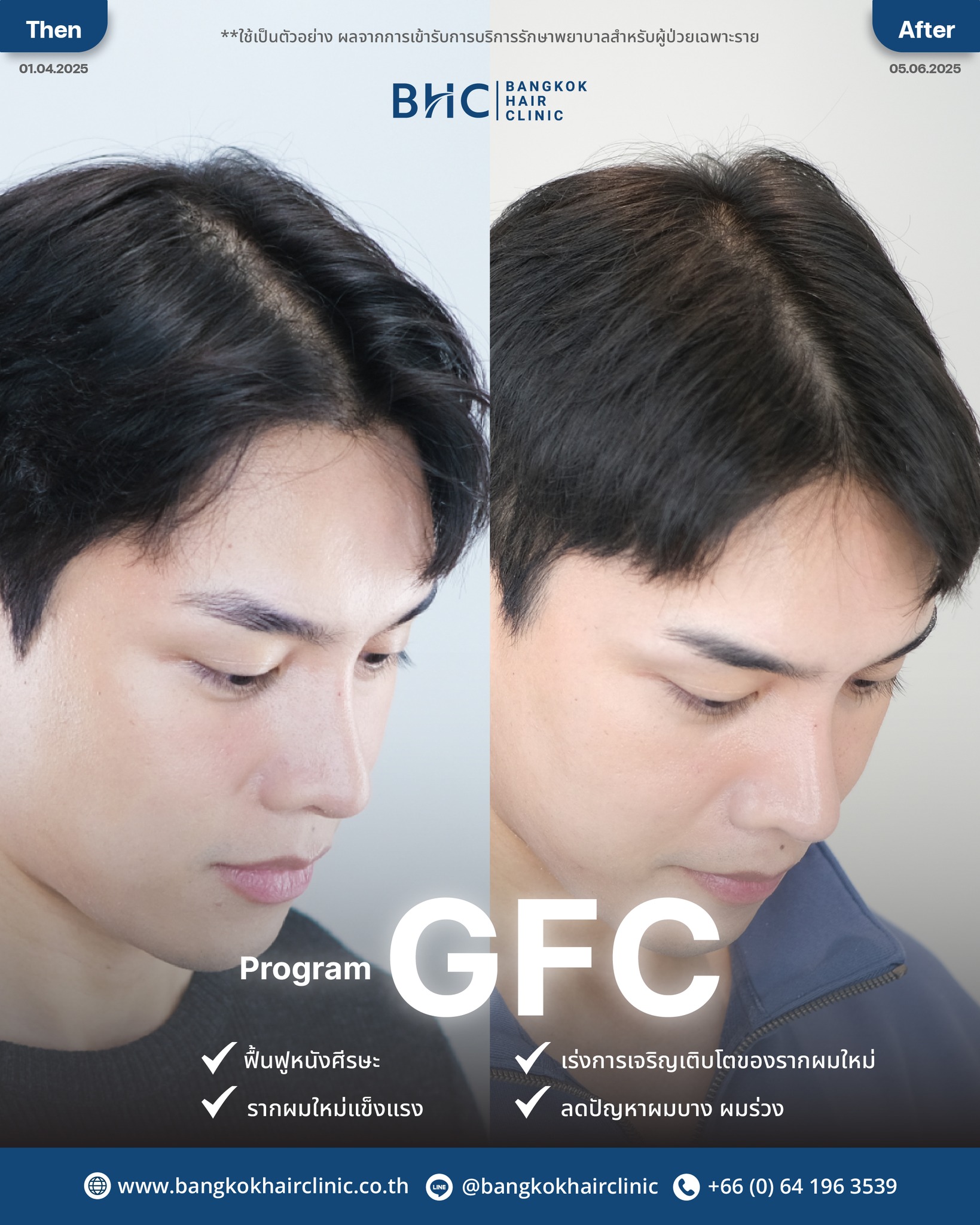 BHC - #REVIEW โปรแกรมฉีดกระตุ้นผม GFC . เทียบให้เห็นชัด ระหว่างก่อนทำ ...