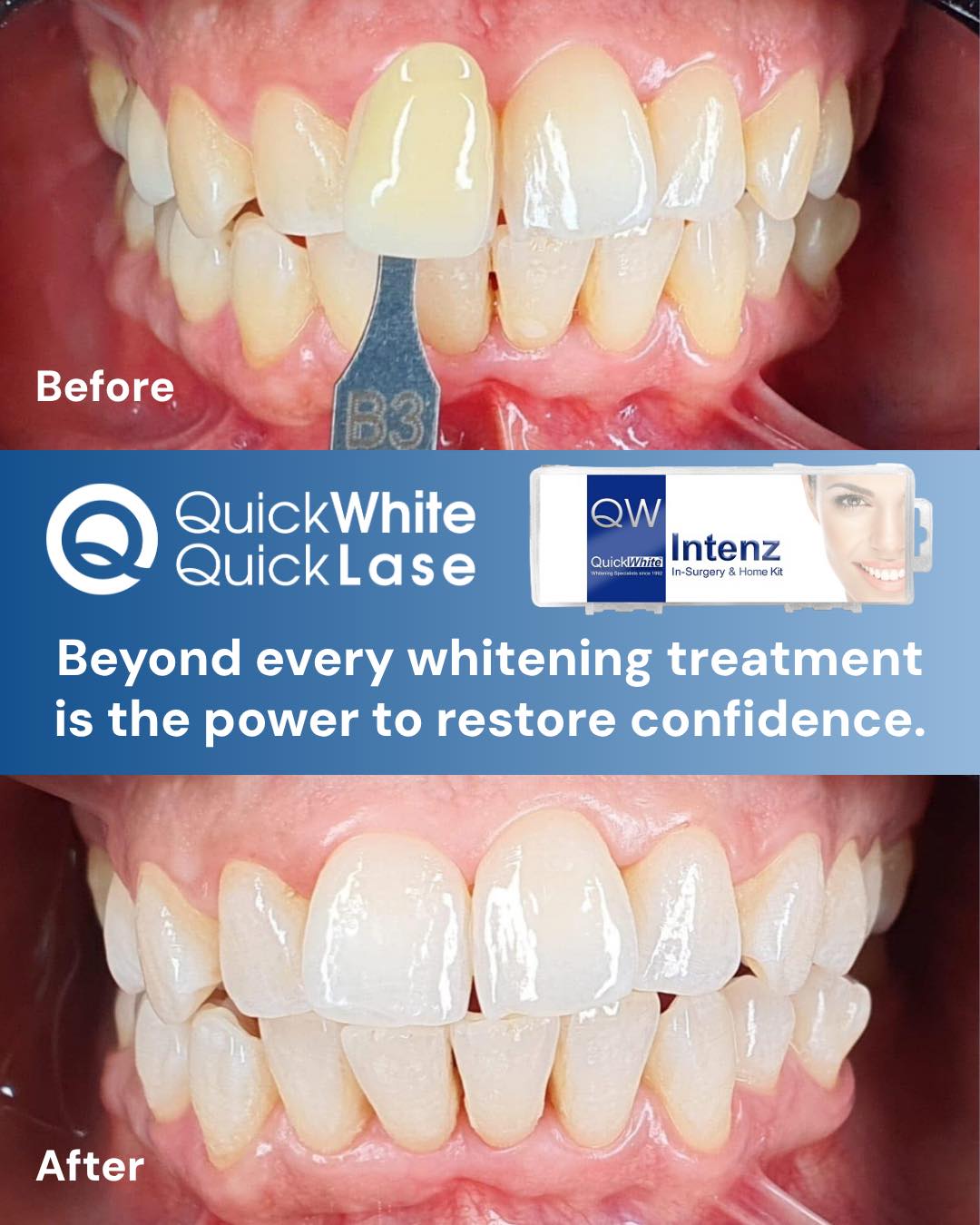 Quicklase Lasers | Canterbury