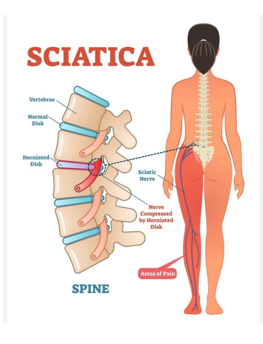 Doc - Causes of Sciatica Sciatica can be caused by any process that may ...