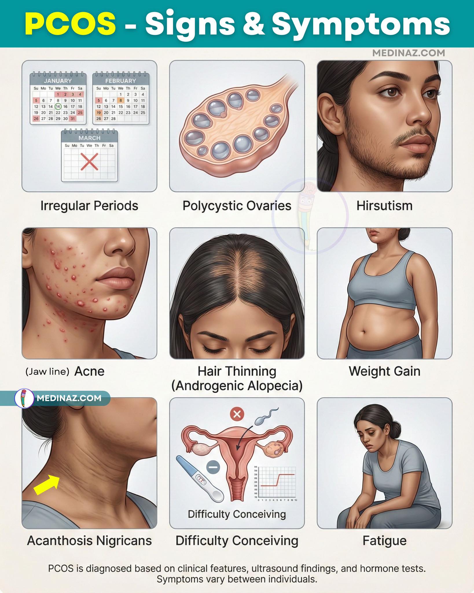Medinaz - 🟣 PCOS (Polycystic Ovary Syndrome): Signs &... | Facebook