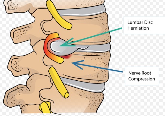Amplify - DISC HERNIATION 101: What’s REALLY Happening Inside Your ...