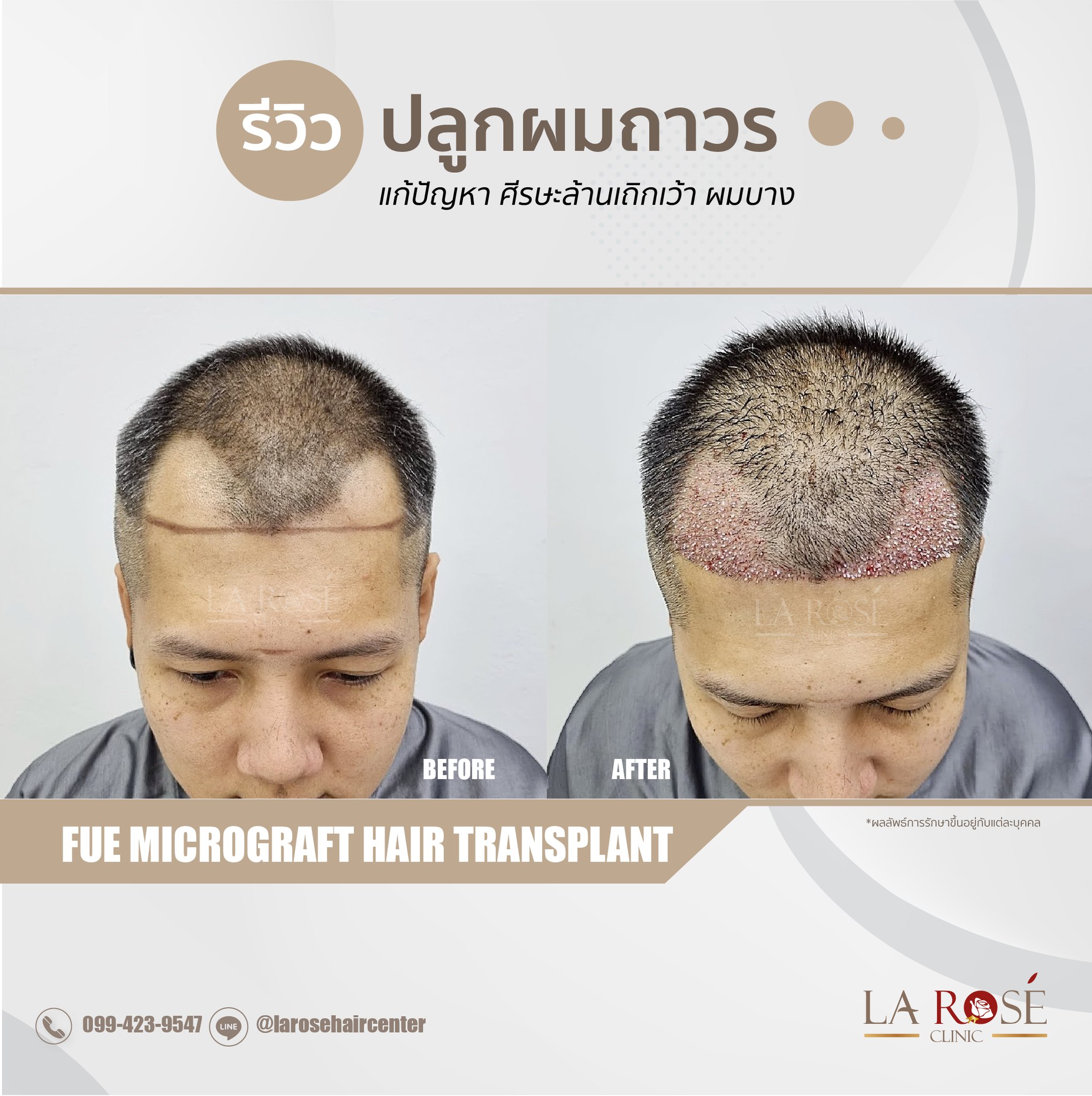เ... - Larose Clinic Hair Center ปลูกผมถาวร FUE Micrograft DHI