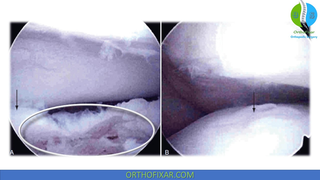 Medial Hamstring Reflex... - OrthoFixar - Orthopedic Surgery | Facebook
