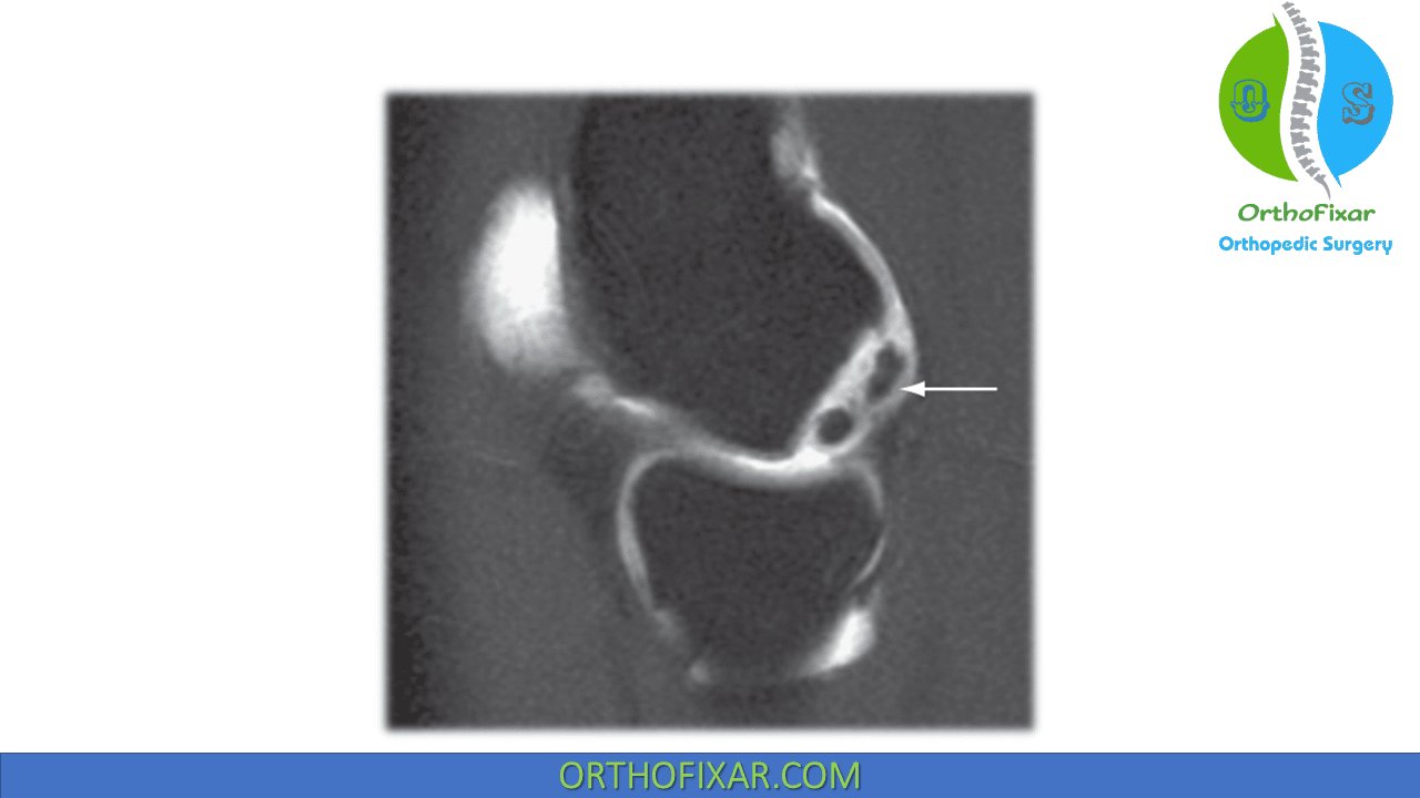 Medial Hamstring Reflex... - OrthoFixar - Orthopedic Surgery | Facebook