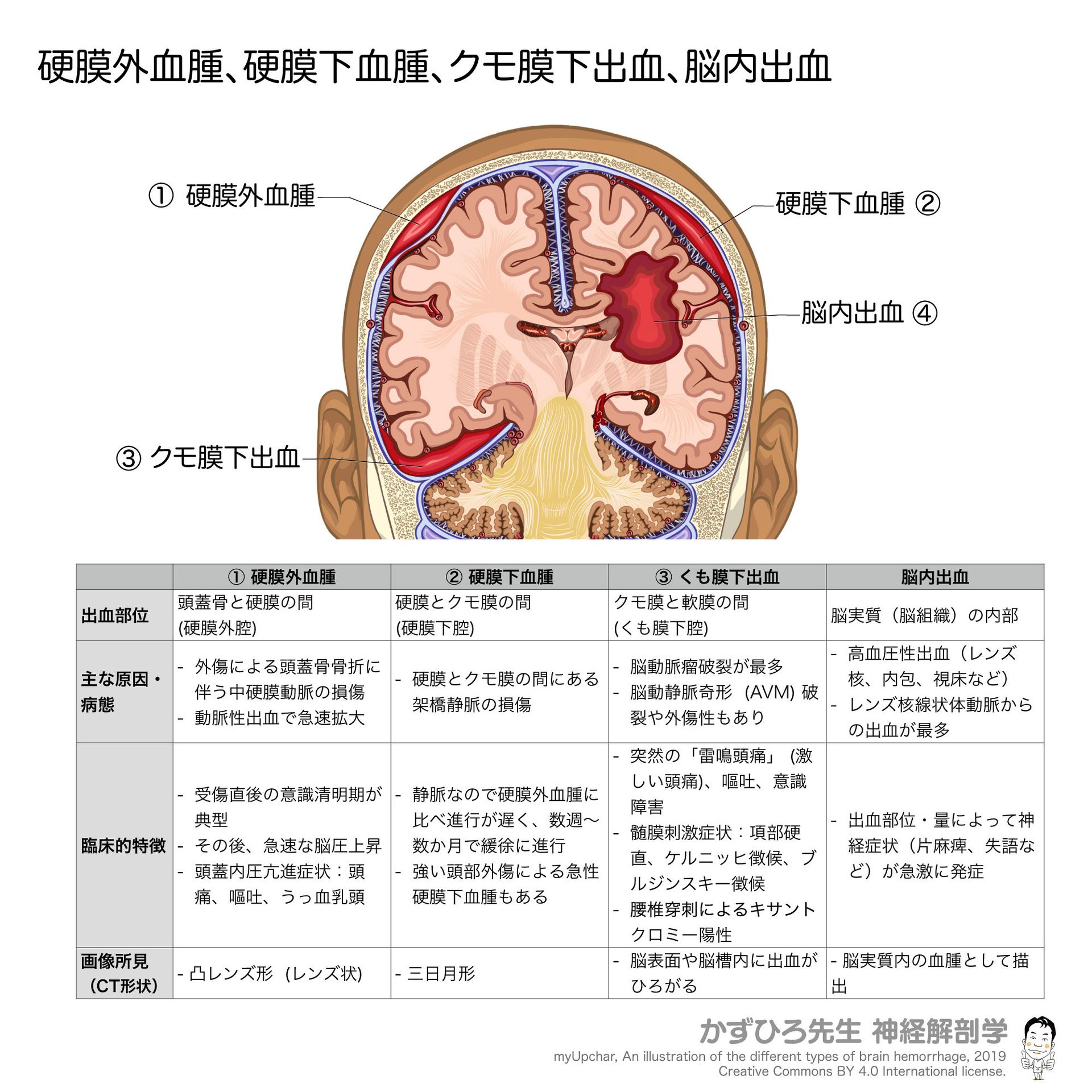 かずひろ先生の【徹底的国試対策】解剖学 - 頭の中の出血は「どこに血がたまるか」で特徴が変わる。 ①硬膜外血腫：頭蓋骨と硬膜の間。動脈性で増え ...