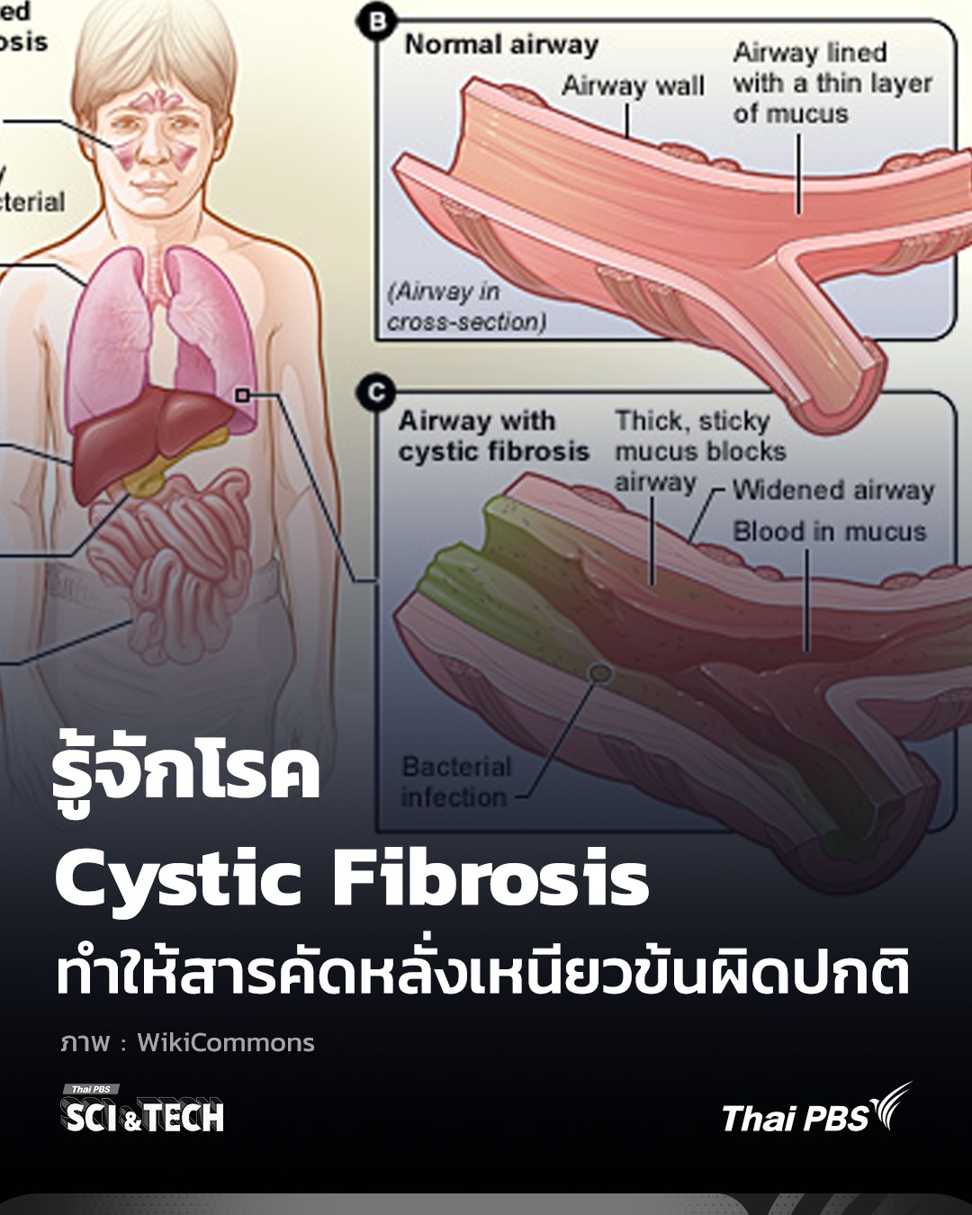 รู้จักโรค #CysticFibrosis ทำให้... - Thai PBS Sci & Tech | Facebook