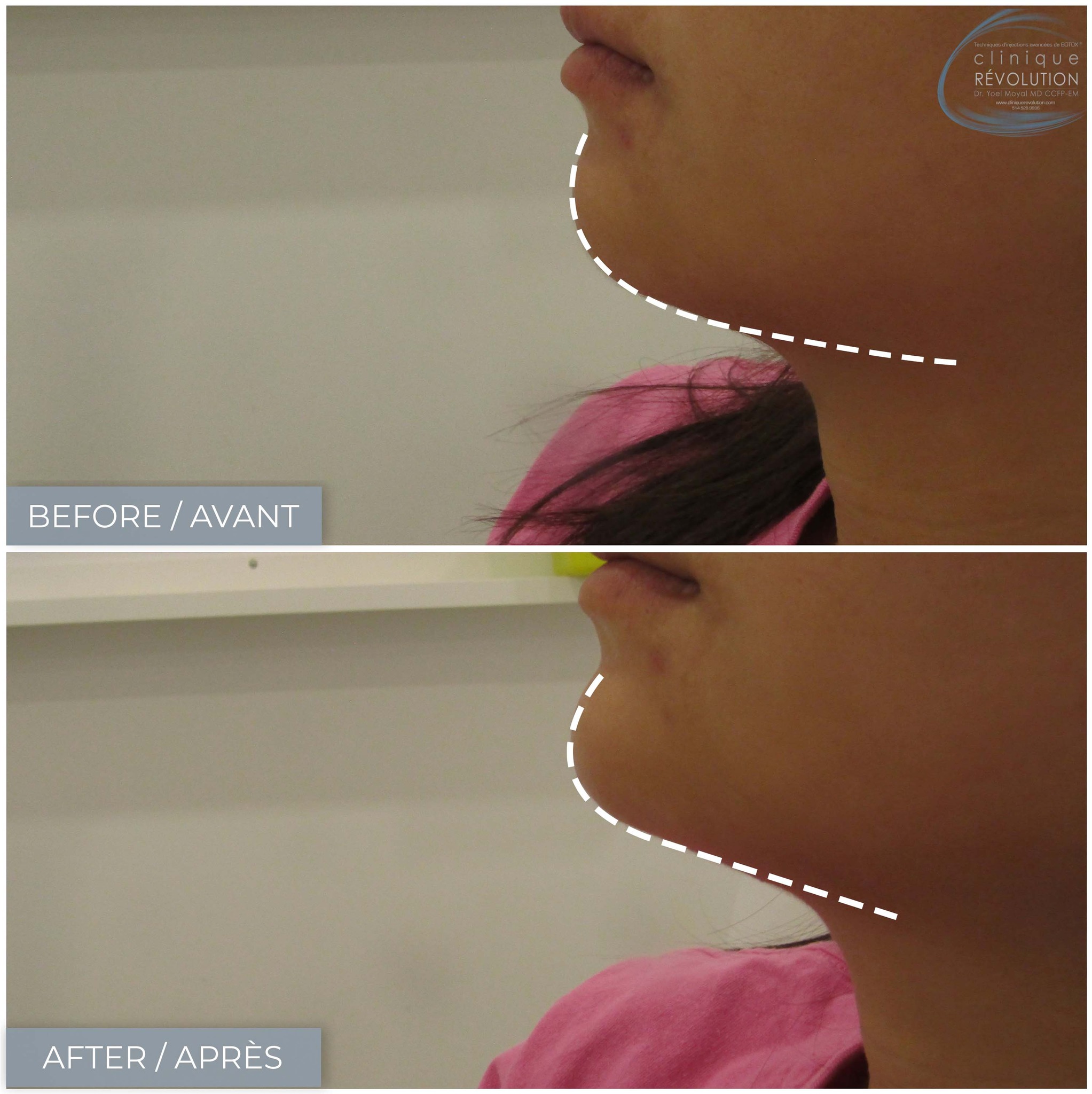 Clinique Révolution du Plateau - 💉Correction des proportions et de la ...