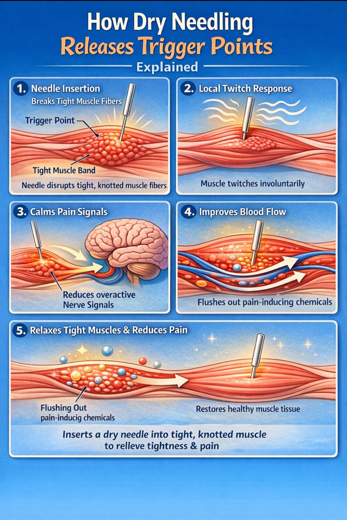 Steve - I regularly get asked how dry needling helps with pain, here’s ...