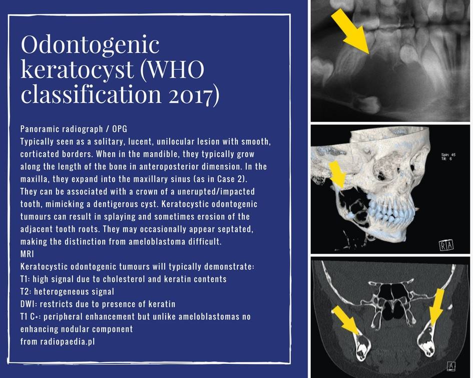 Odontogenic Keratocyst Radiology
