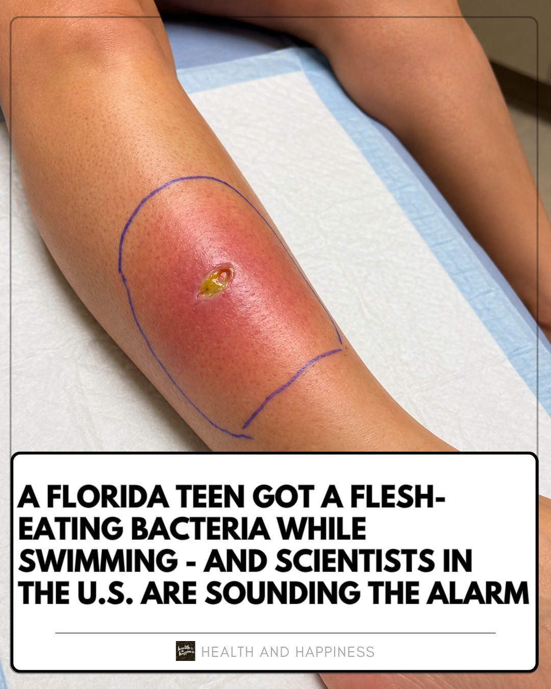 A 17-year-old ended up in the hospital after he got a flesh-eating bacteria while swimming at a park with his siblings. >>> https://www.wymt.com/2026/06/15/teen-fights-flesh-eating-bacteria -he-got-while-swimming-park-with-siblings