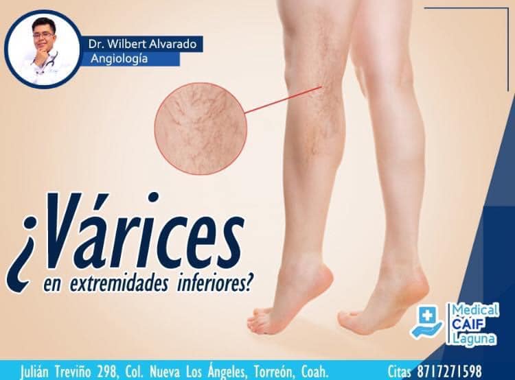 Medical Caif Laguna - 🔹Valoración y tratamiento para várices en ...