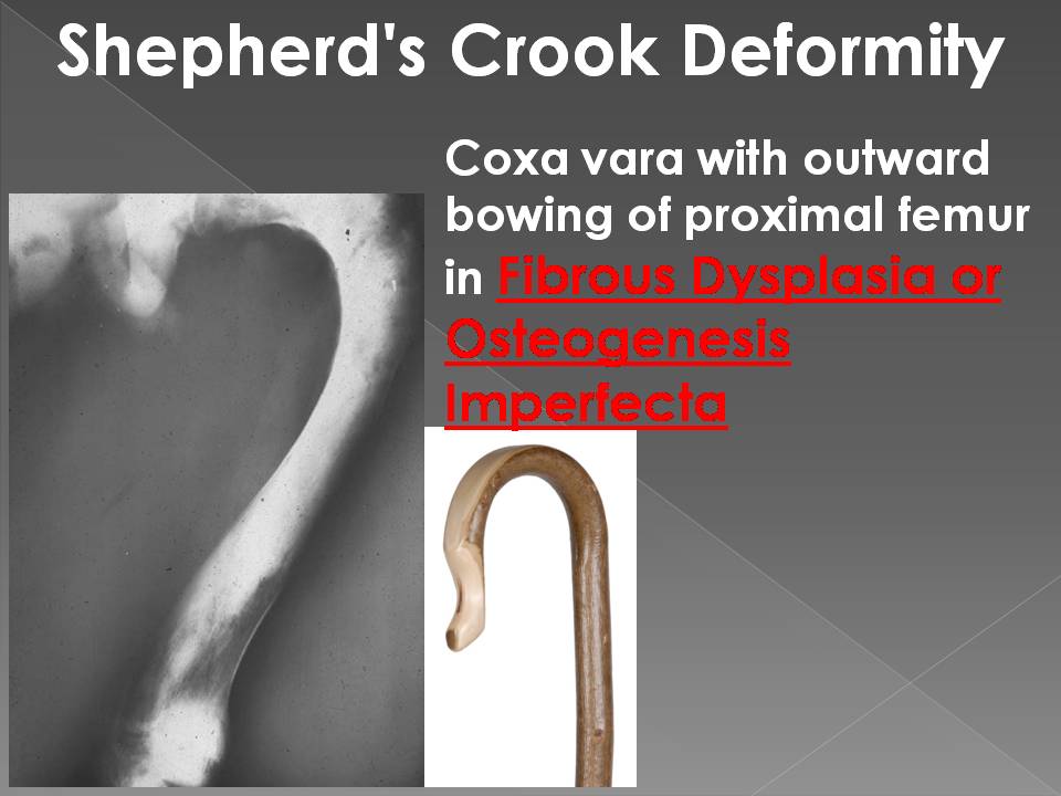SHEPHERD CROOK DEFORMITY - Radiology Classroom