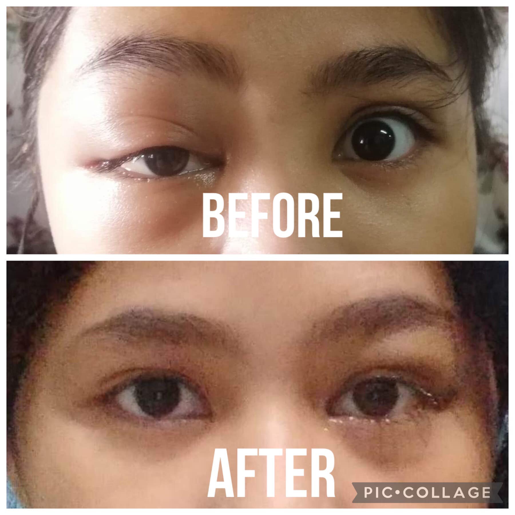 Ito ang Pre-septal... - First Choice Eye and Vision Clinic
