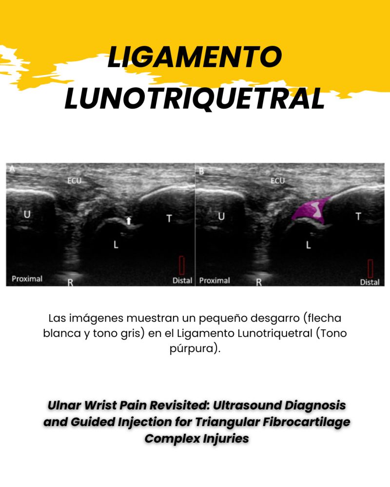 Tempo - 🔍 ¿Dolor ulnar de muñeca? Una de las causas más complejas y ...