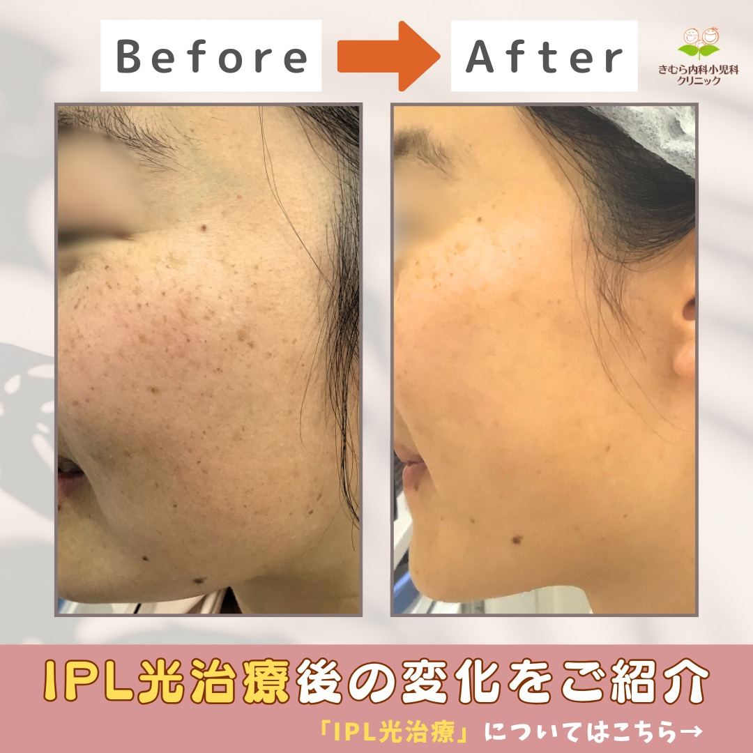 きむら内科小児科クリニック - 📸 IPL光治療のビフォーアフターをご紹介します シミ・くすみ・赤み・毛穴…... | Facebook