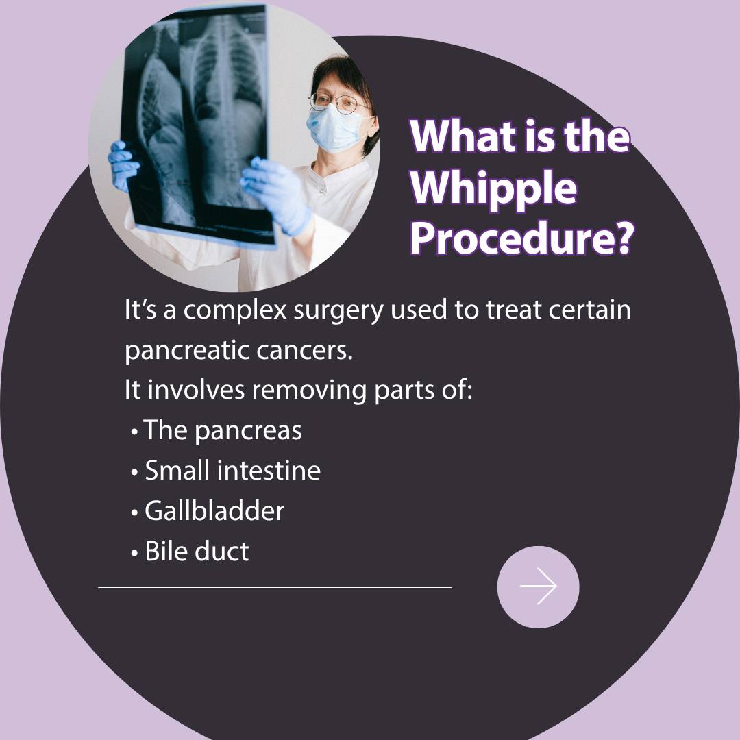 The Whipple Procedure is one of the most complex surgeries used to treat pancreatic cancer, but it can also be one of the most important. It involves removing and reconstructing parts of