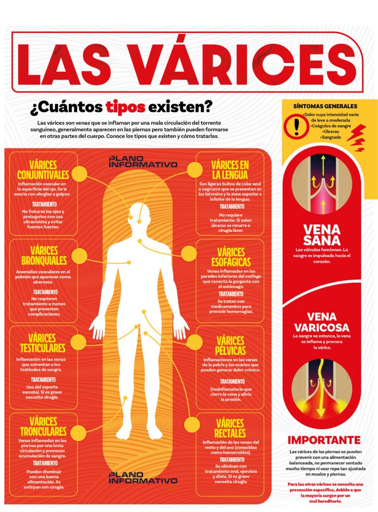 QueTal - #Info | 🦵 Las várices son venas dilatadas causadas por una ...