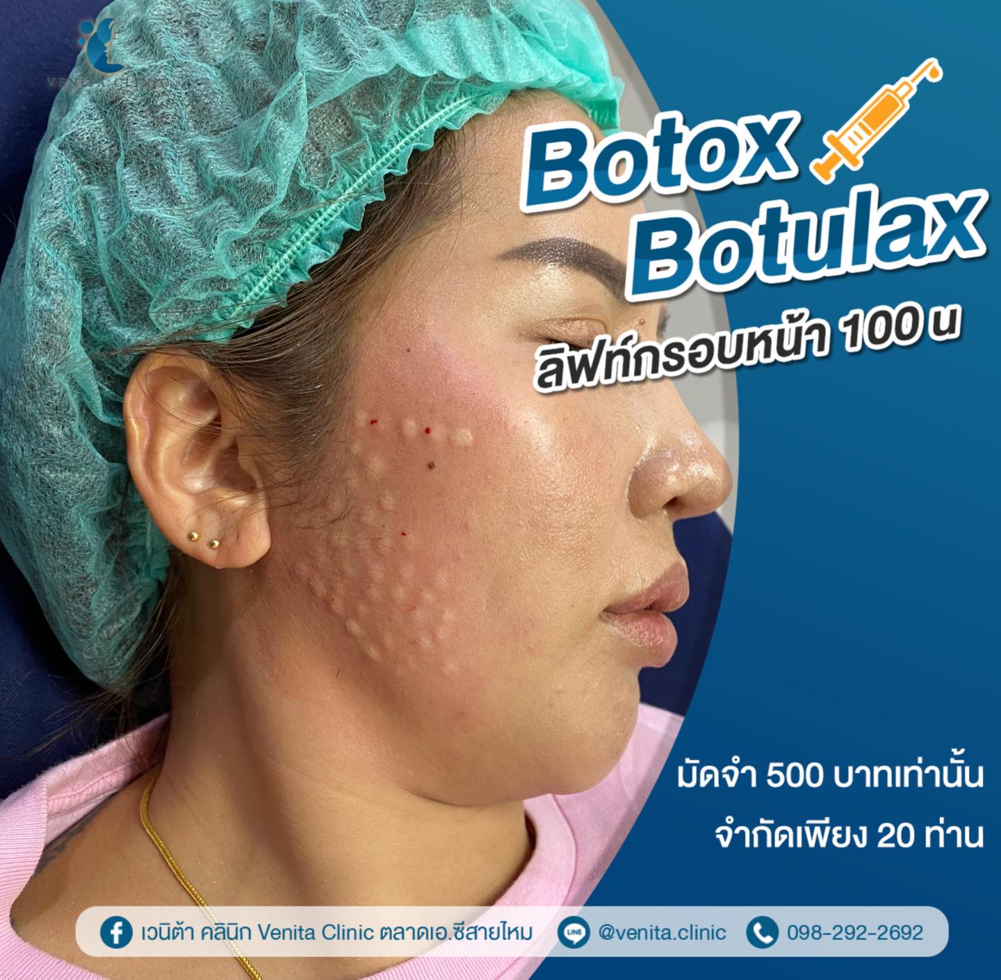 ‼️ลิฟท์กรอบหน้า แบบจัดเต็ม‼️ Botox botulax 100u 2,500.- ️สำหรับลูกค้า ...