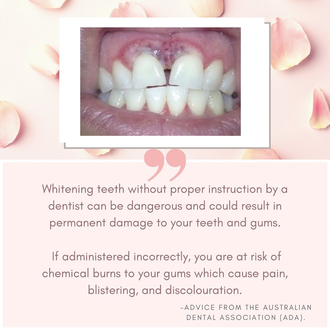 Illuminate Your Smile - Chemical burns and whitening . Gingival (gum ...
