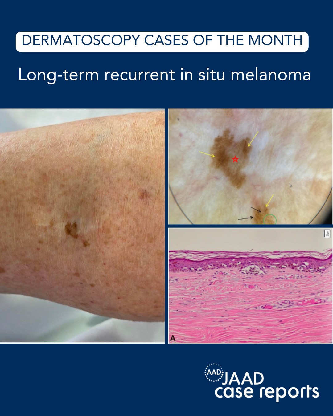 Long term recurrent in situ melanoma case report