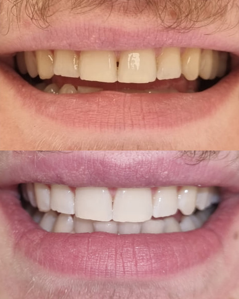 Teeth whitening in the mall of georgia