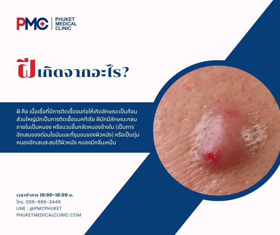 ฝี เกิดจากอะไร? ฝี... - Phuket medical clinic -PMC Clinic