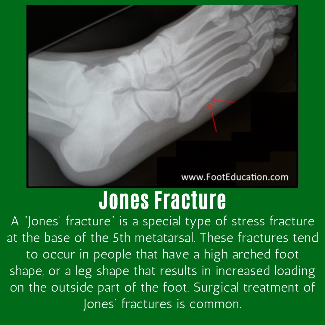 footEducation - That “little ache” on the outside of your foot? Don’t ...