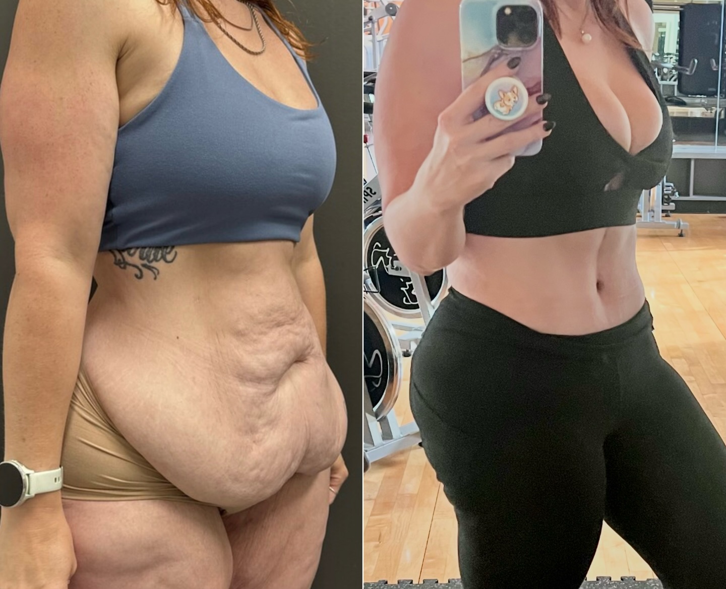 Fleur-de-lis tummy tuck for massive weight loss