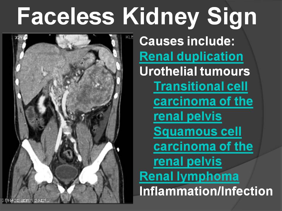 FACELSS KIDNEY SIGN - Radiology Classroom | Facebook