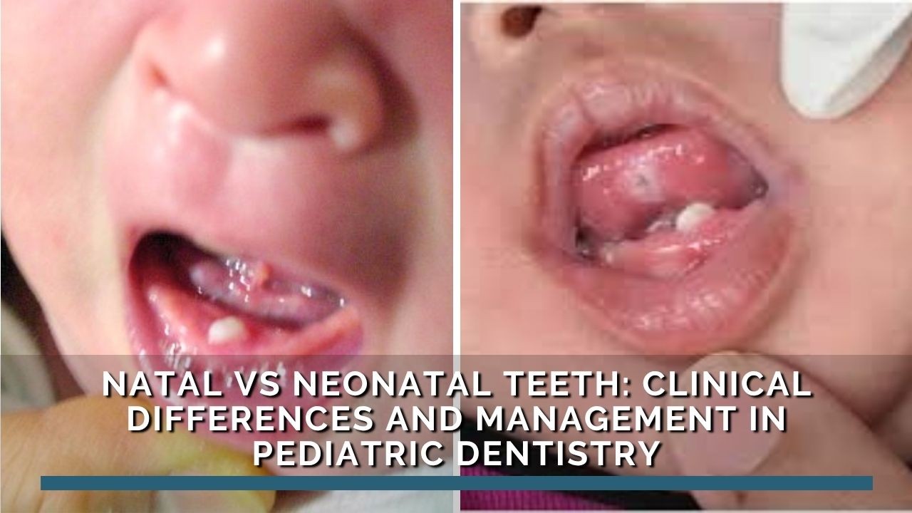 Odontopediatric - Natal vs Neonatal Teeth: Clinical Differences and ...