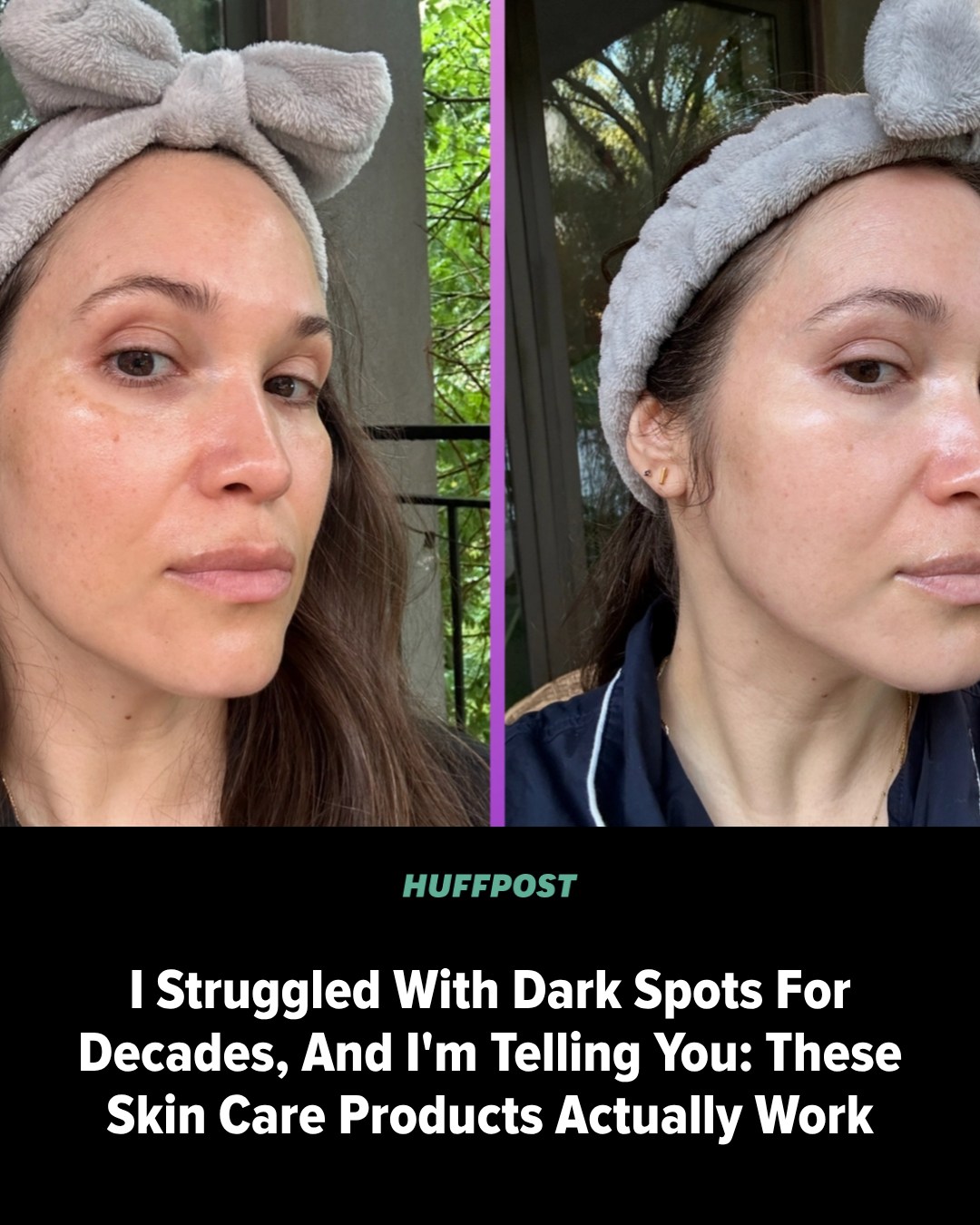 huffington post and glutathione Much to my delight, surprise relief, my skin has radically improved in the past 24 months. Read more: https://www.huffpost.com/entry/hyperpigmentation-dark-spots-melasma-skin-care-2026_l_6ab5223ae4b07a6b0992ac62?ref=bffbhuffpost&ncid_tag anti inflammatory