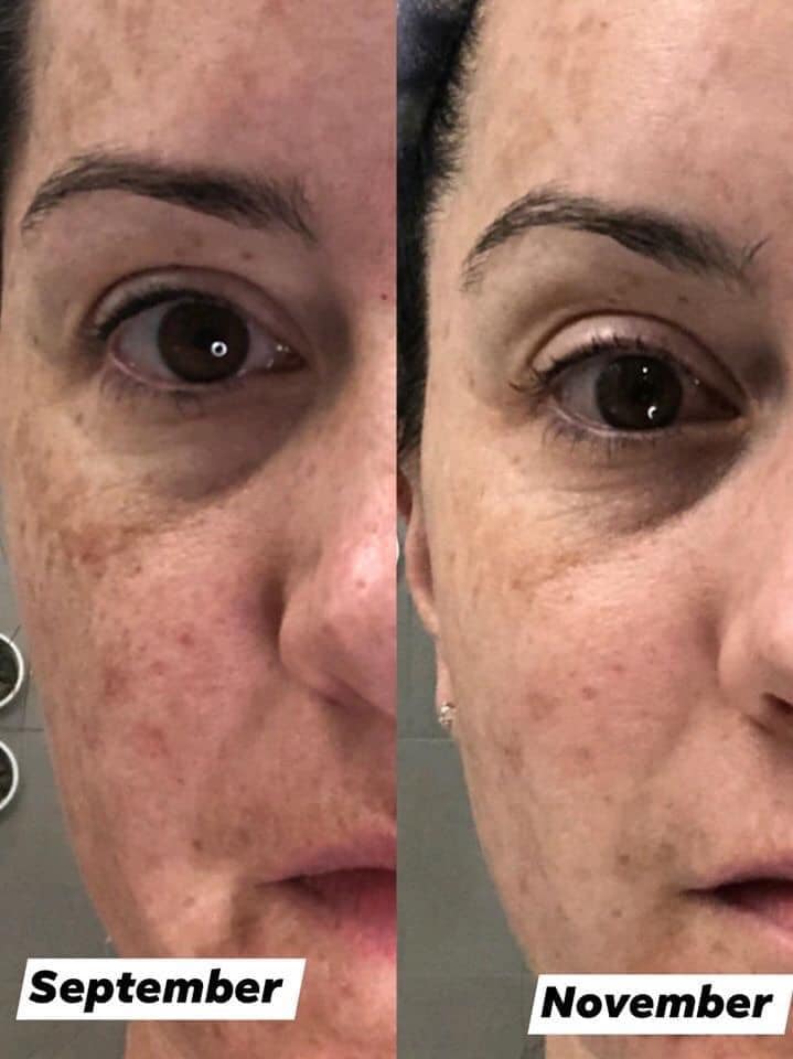 For the first time in my life, I have clear skin. My eyes shine brighter and I don't have the shadow of melasma on my upper lip and under my eye. I