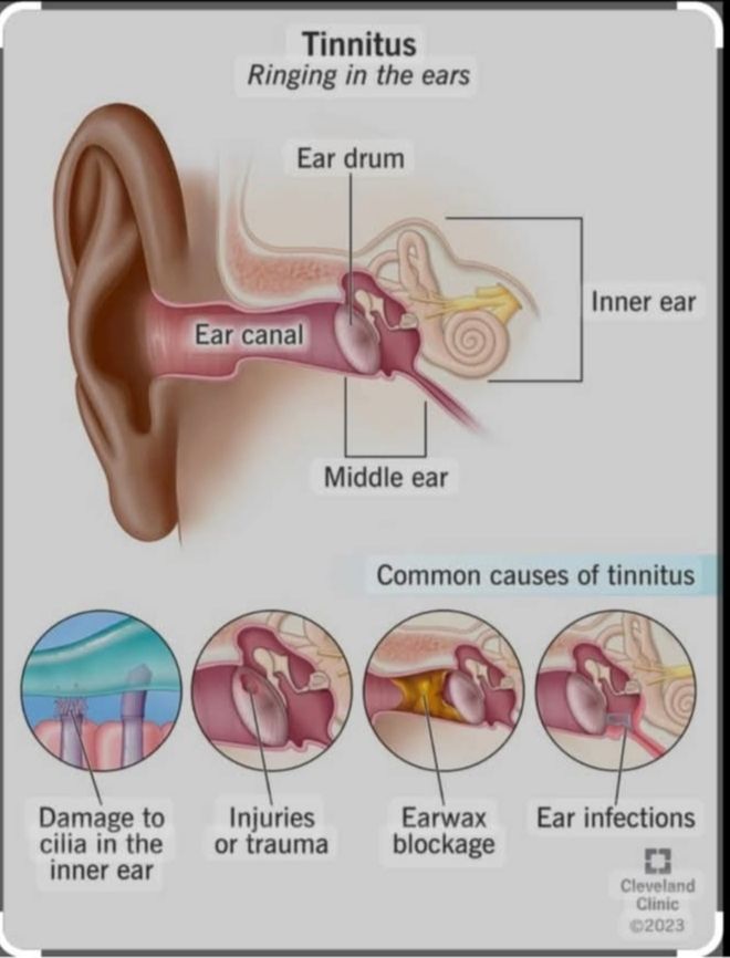 জার্মানি - #TINNITUS Tinnitus is a condition in which a person hears ...