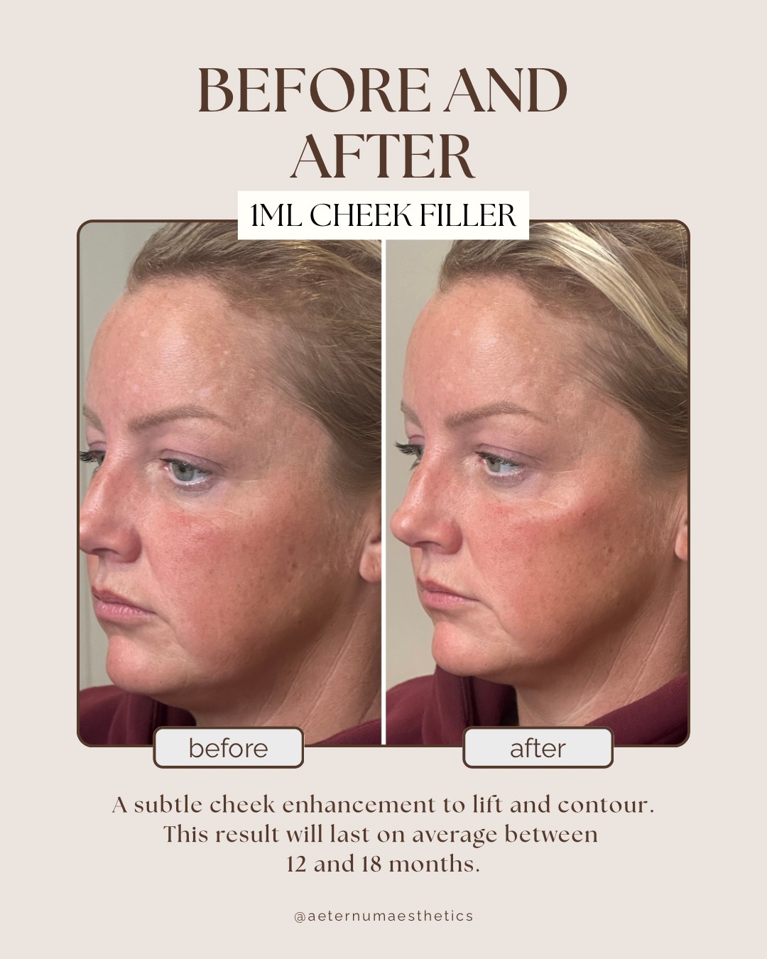Aeternum - Subtle lift. Soft contour. Beautifully balanced. This ...