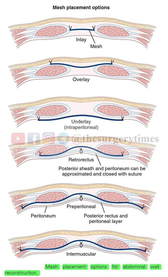 Types of Mesh in... - Dr Qamar Shahzad Joia General Surgeon