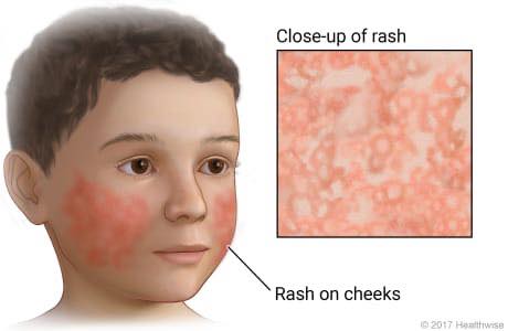 Eskasoni - What You Need to Know About Fifth Disease (Erythema ...