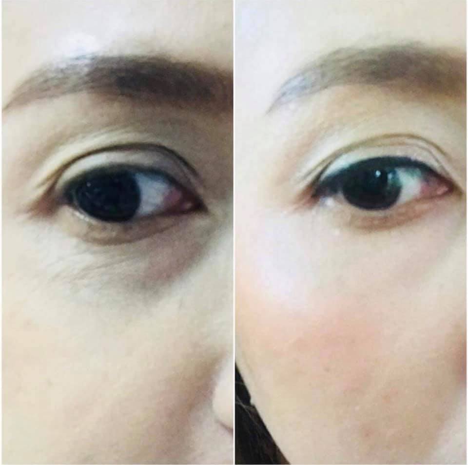 Micro Eye Patch คืออะไร?? Microeye... - Millionaires Club