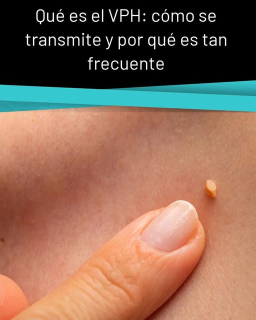 La 100 FM - Qué es el VPH: cómo se transmite y por qué es... | Facebook