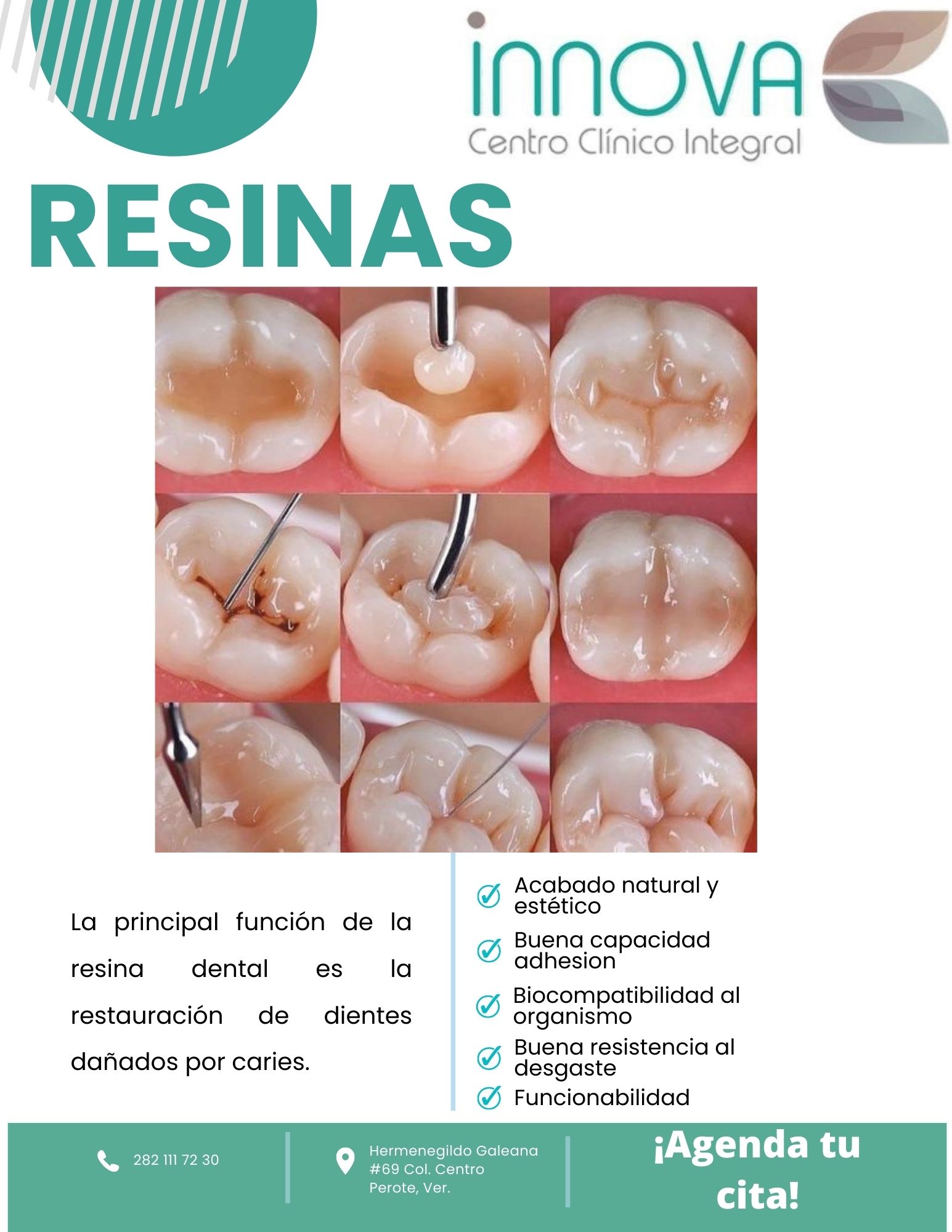 Clínica - ¿Para que sirve una resina dental? 😁 La resina dental es un ...