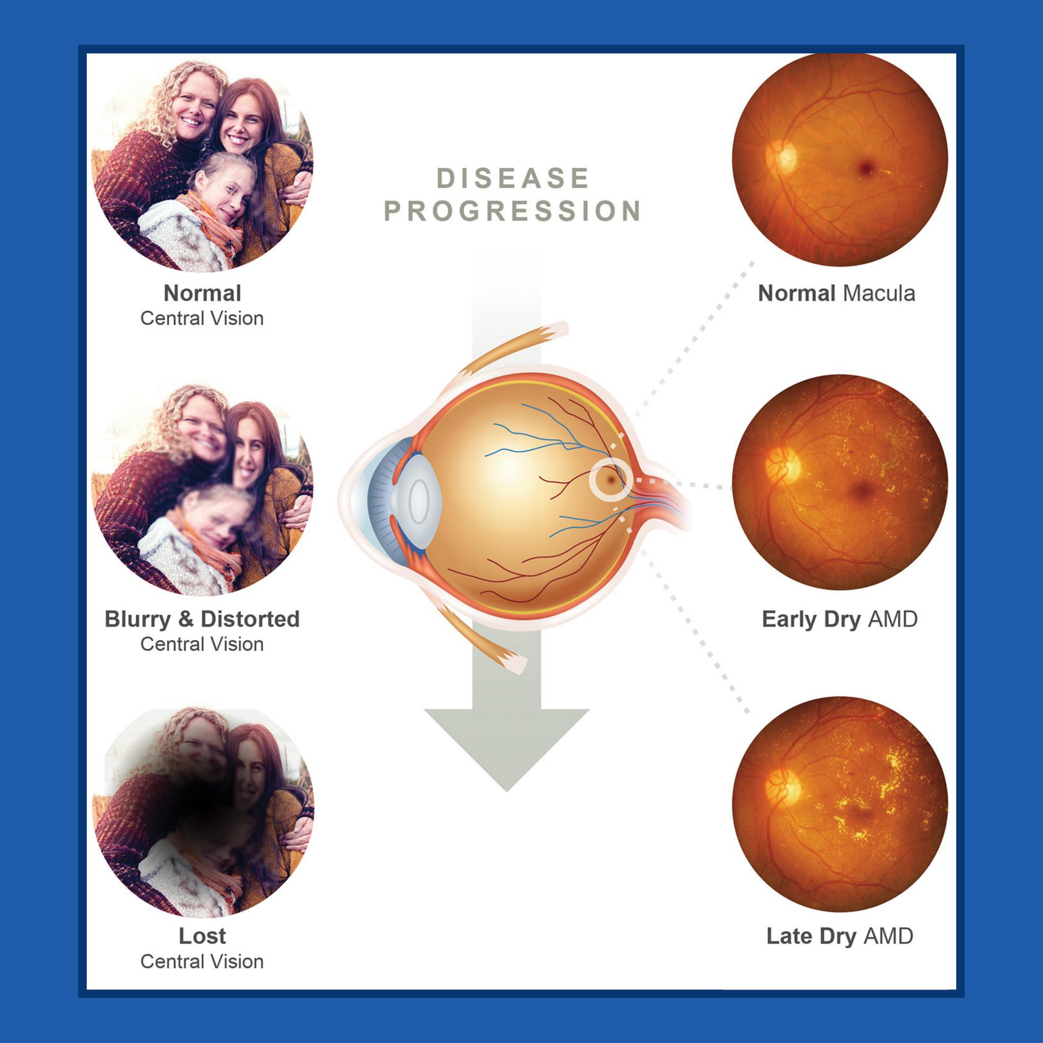 Judy Wolven - This is what I have in my right eye. I am... | Facebook