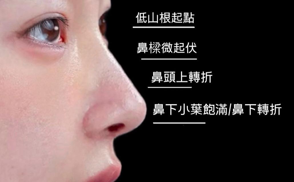 林日新 好鼻醫師/顏面整形 - 耳軟骨+ Goretex 好看的鼻子應要有理想的鼻額角，通常會建議鼻額角在135-140度左右，追求山根高挺的 ...