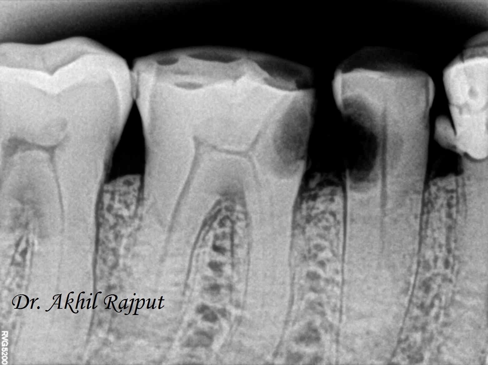 MANAGMENT COMPLEX CASE GUIDE ENDO TOOTH 3.3 NECROTIC AND CALCIFIED