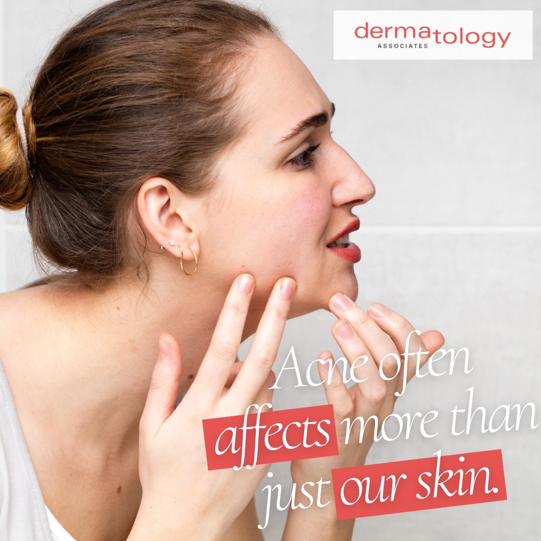 Dermatology - Acne can affect more than just our skin. It can shape our ...