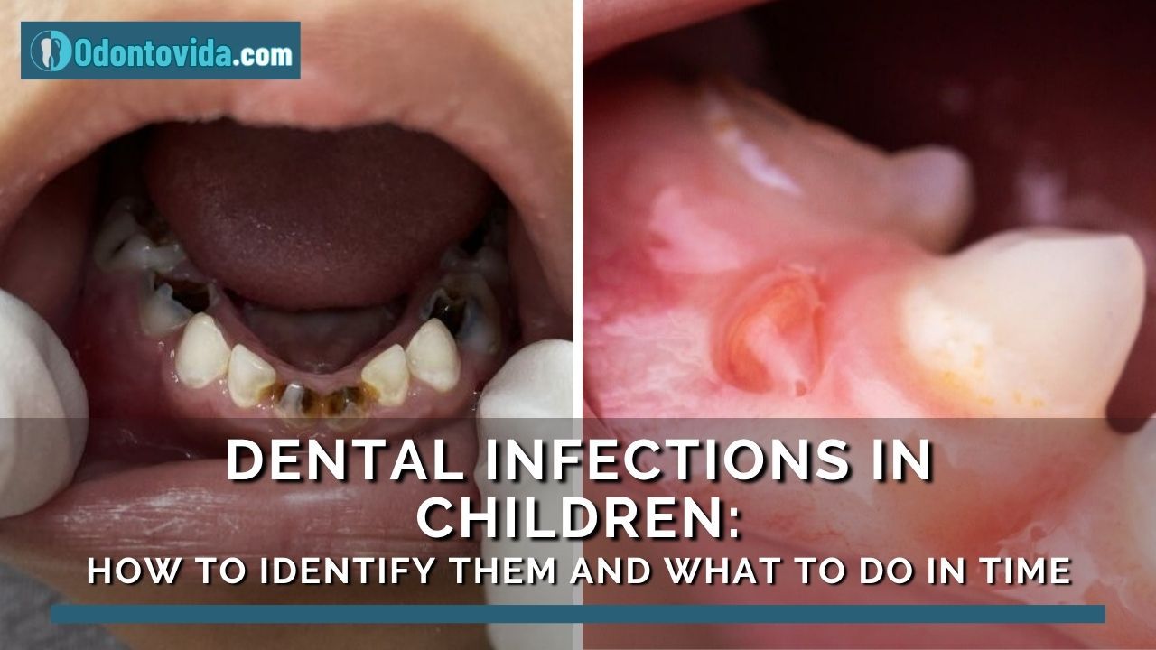 Odontopediatric - Dental Infections in Children: How to Identify Them ...
