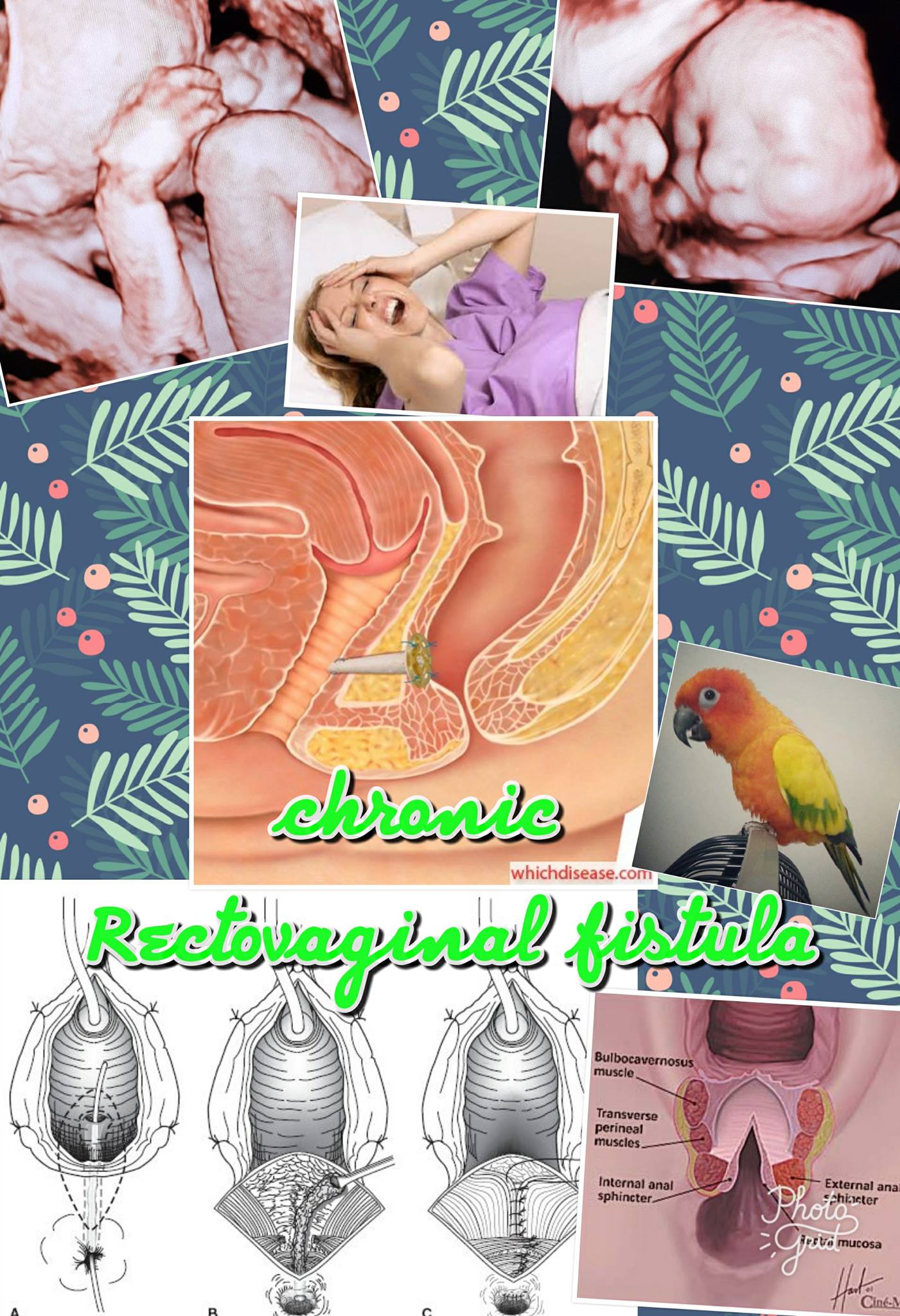Chronic RV fistula... - เรื่องเล่าจากโรงหมอ | Facebook